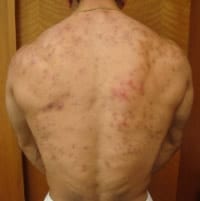 Como evitar acne por esteroides
