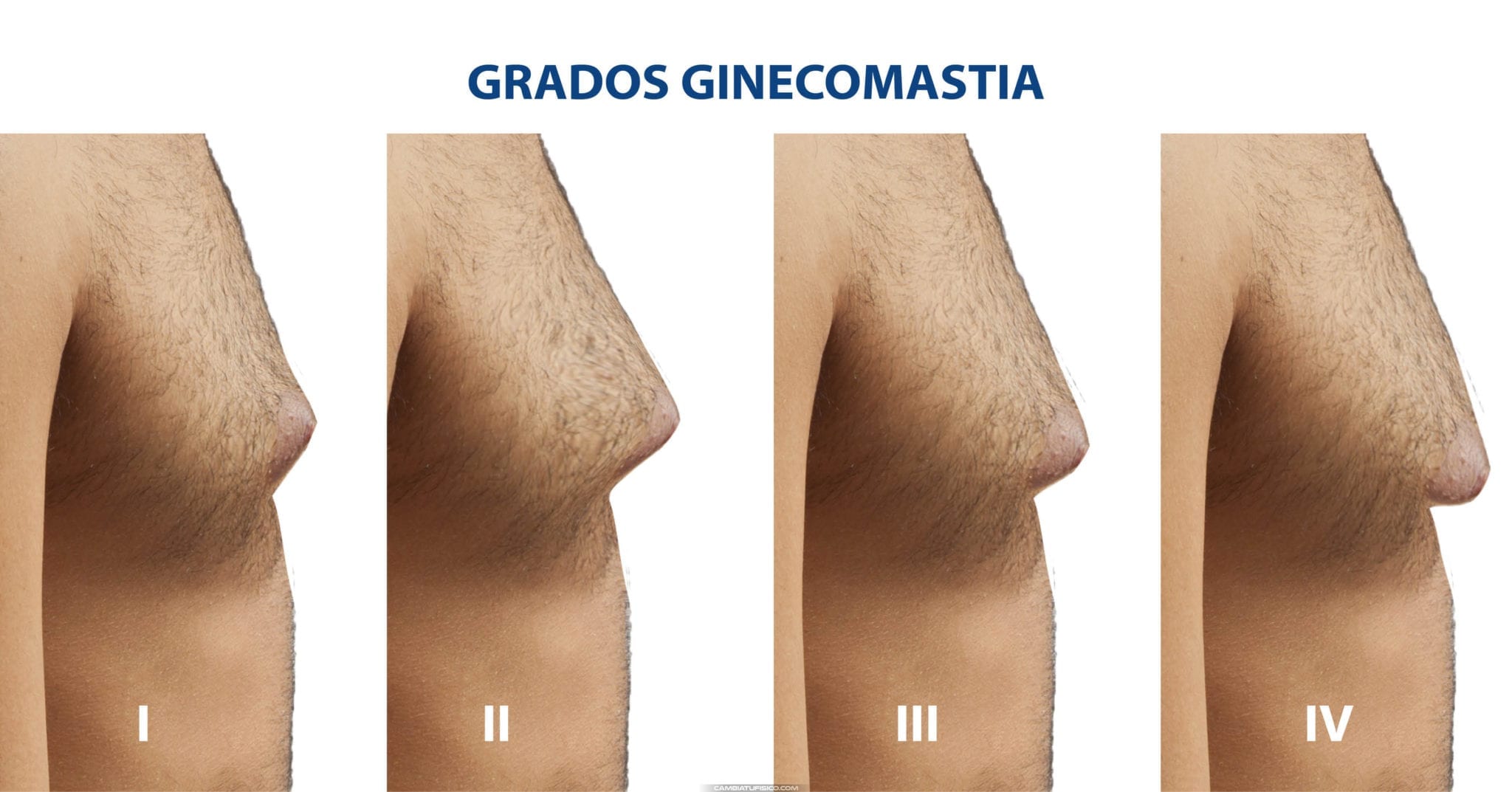 Grados Ginecomastia