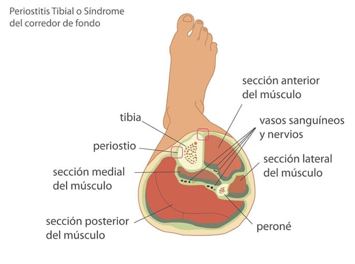 Periostitis tibial