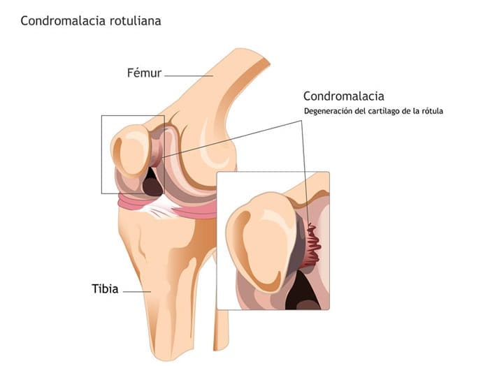 Condromalacia rotuliana