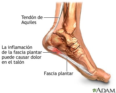 Fascitis Plantar