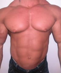 Gynecomastia no steroids