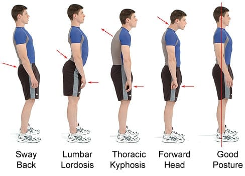 Lordosis Postura Correcta