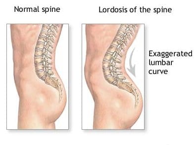 hiperlordosis