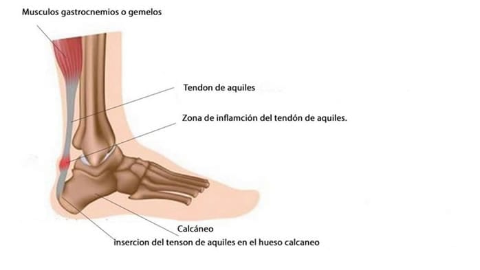 Tendinitis Aquiles