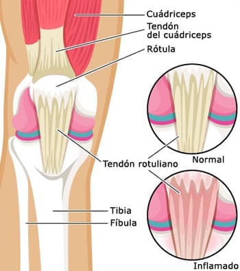 Tendinitis Rotuliana